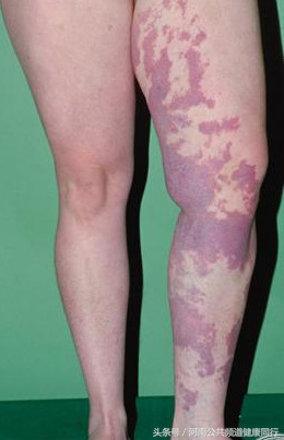 静脉曲张郑大一附院看哪个科,郑大一附院硬化剂治疗静脉曲张