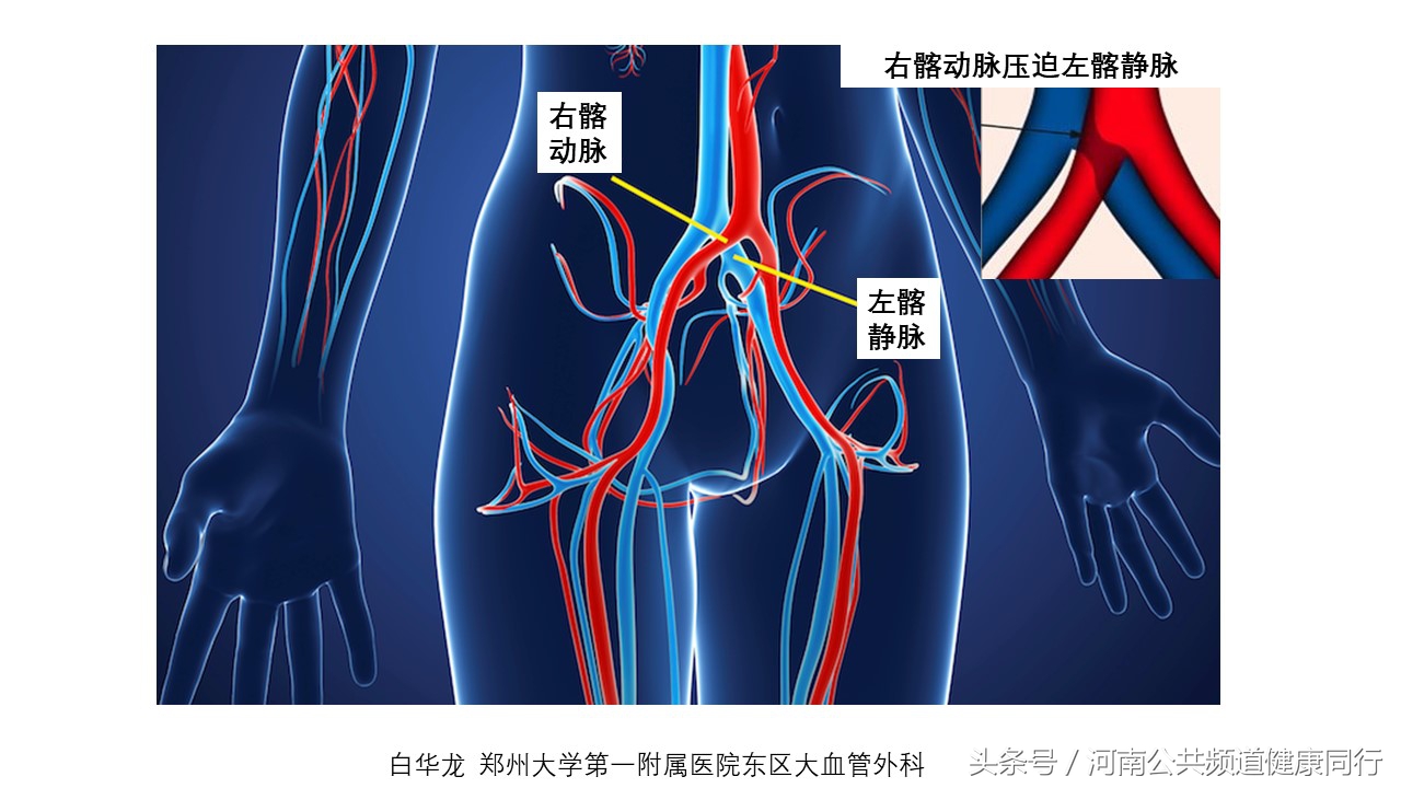 静脉曲张郑大一附院看哪个科,郑大一附院硬化剂治疗静脉曲张