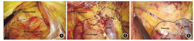 腹腔镜右半结肠癌手术步骤,腹腔镜右半结肠癌根治术术后护理