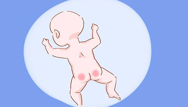 宝宝得了尿布疹怎么办,宝宝尿布疹怎样好得快