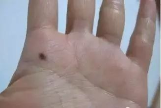 这5种痣是癌的征兆,出现这10个症状要小心可能有肿瘤