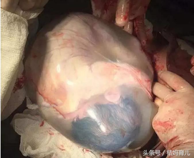 25岁孕妇产下8斤男孩,23岁孕妈妈剖腹产大出血