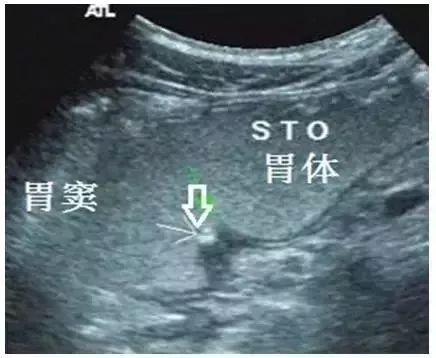 典型胃溃疡超声声像图，不输于做胃镜！