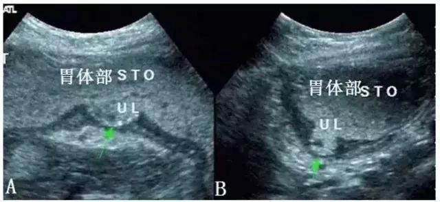 典型胃溃疡超声声像图，不输于做胃镜！