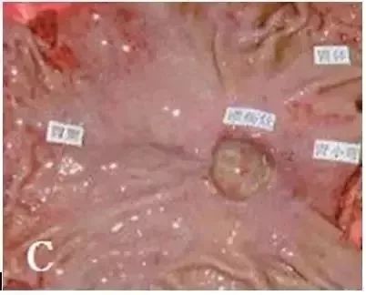 典型胃溃疡超声声像图，不输于做胃镜！