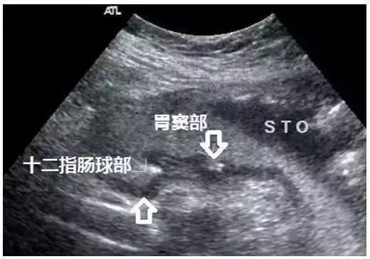 典型胃溃疡超声声像图，不输于做胃镜！