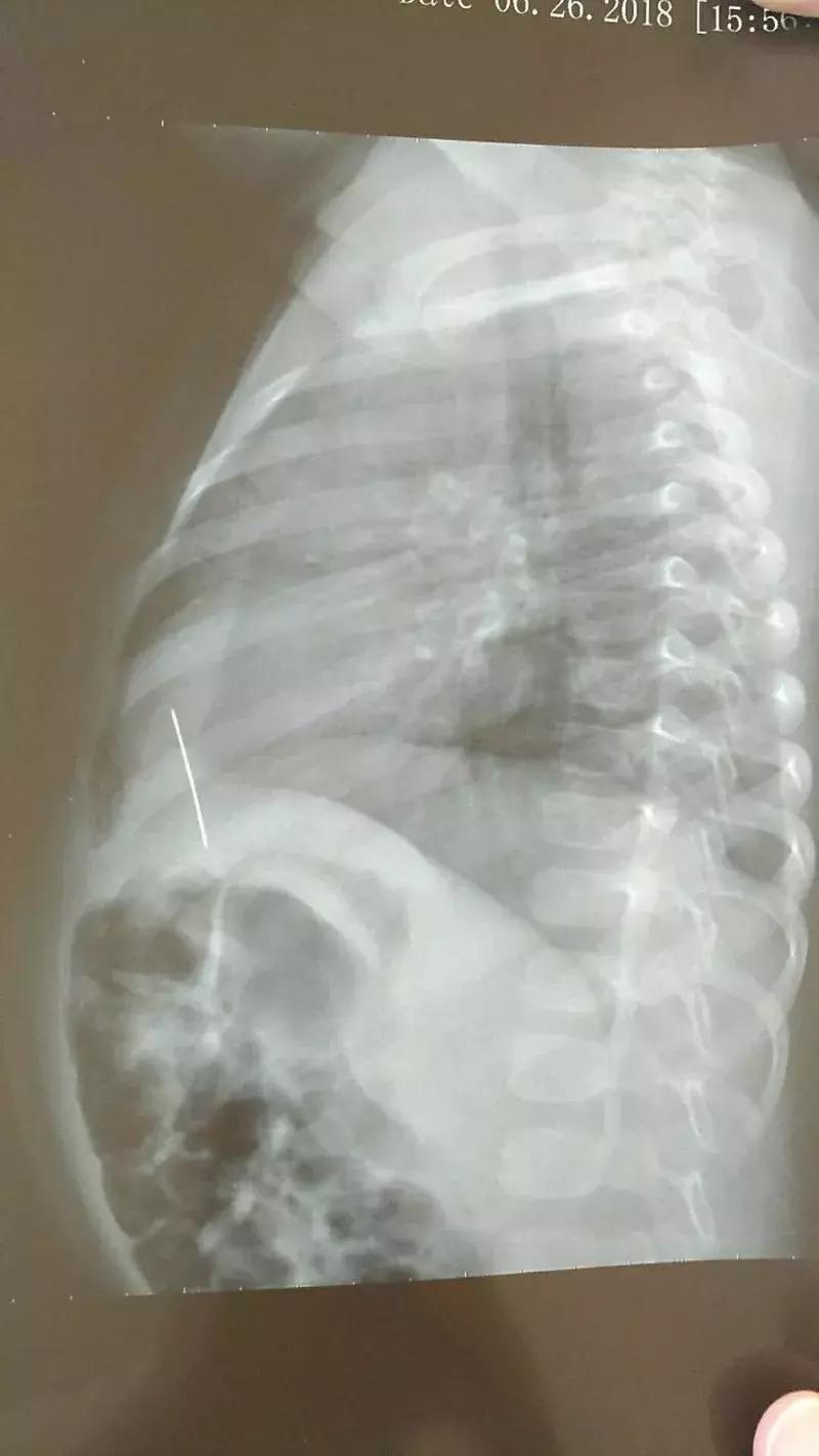 一岁的宝宝胸腔都高吗,一岁半的宝宝胸腔有点高