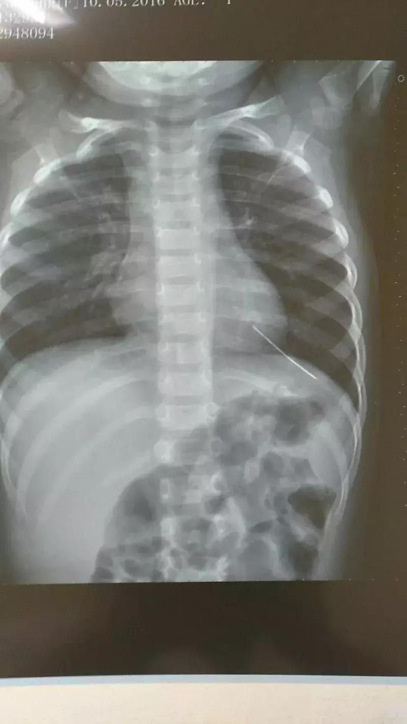 一岁的宝宝胸腔都高吗,一岁半的宝宝胸腔有点高