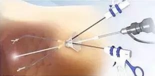 哪些手术可以做腹腔镜三孔手术,单孔腹腔镜适合做什么手术