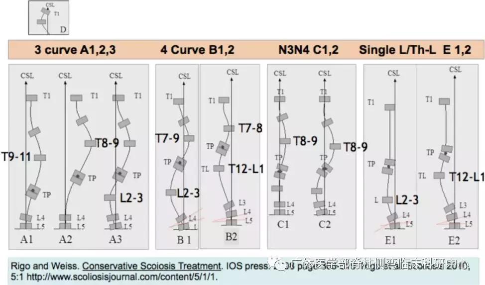 Scolioscan三维超声实现姿势矫正可视化(三)——近胸弯