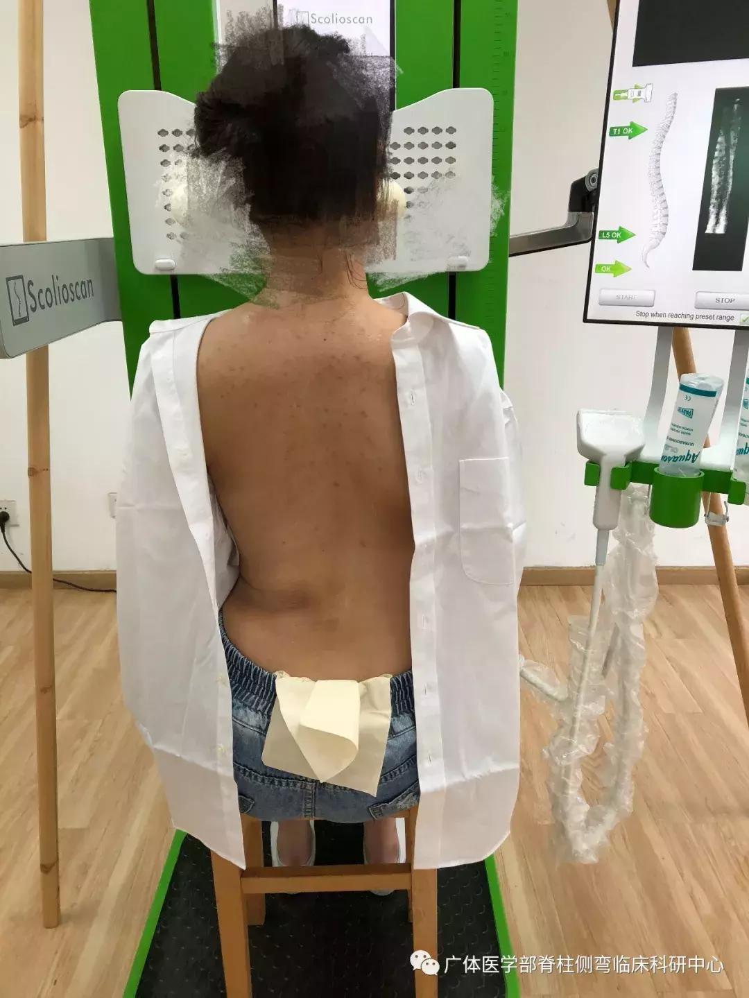 Scolioscan三维超声实现姿势矫正可视化(三)——近胸弯