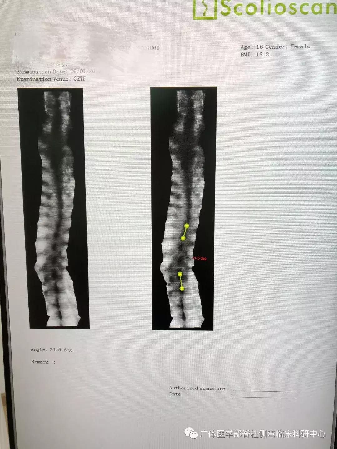 Scolioscan三维超声实现姿势矫正可视化(三)——近胸弯