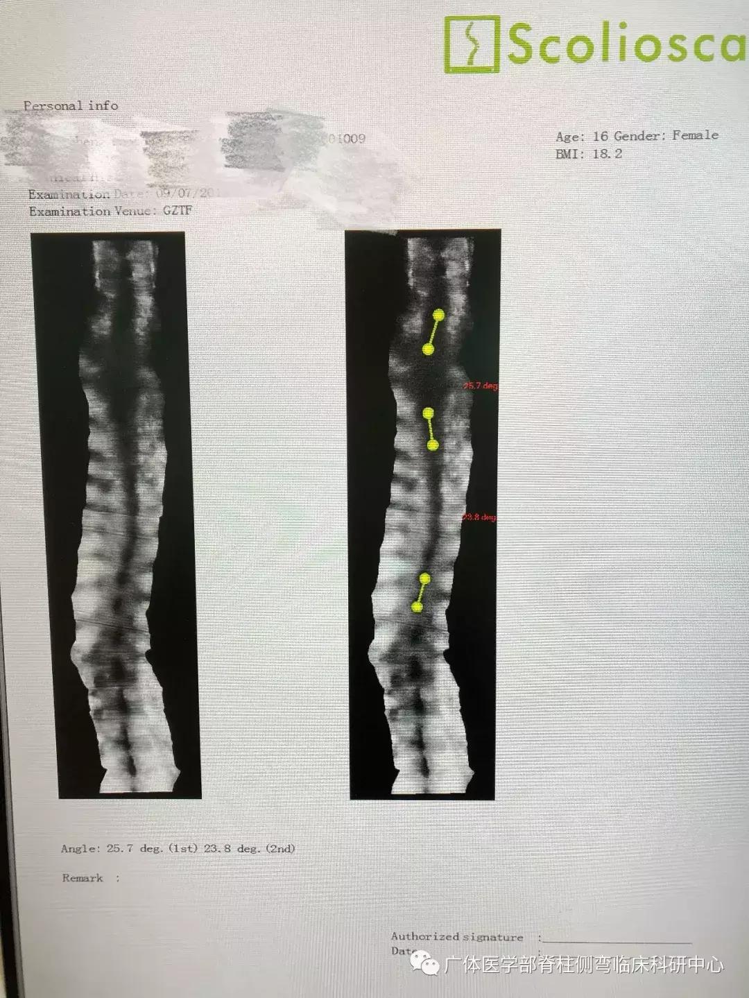 Scolioscan三维超声实现姿势矫正可视化(三)——近胸弯