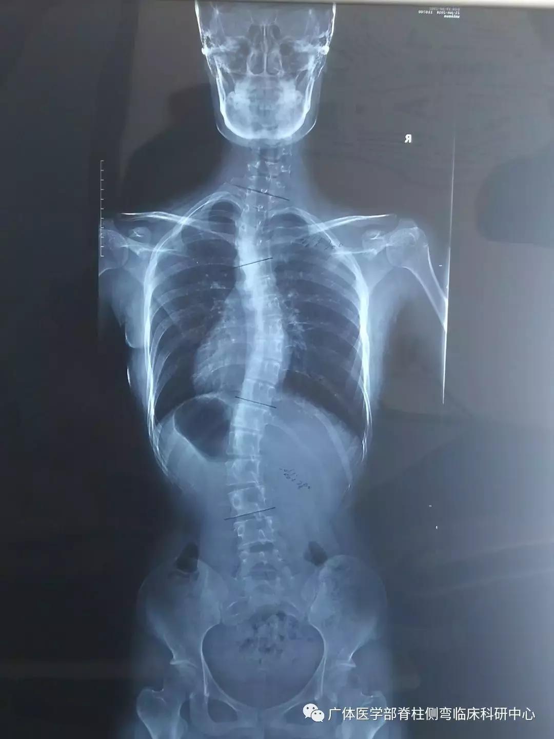 Scolioscan三维超声实现姿势矫正可视化(三)——近胸弯