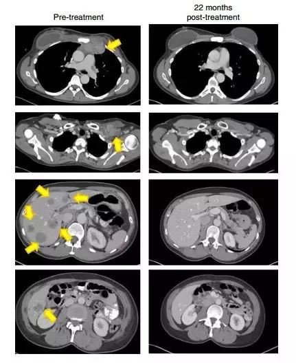 肿瘤细胞免疫治疗是什么,细胞免疫治疗视频大全