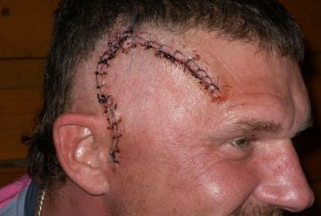 肿瘤细胞免疫治疗是什么,细胞免疫治疗视频大全