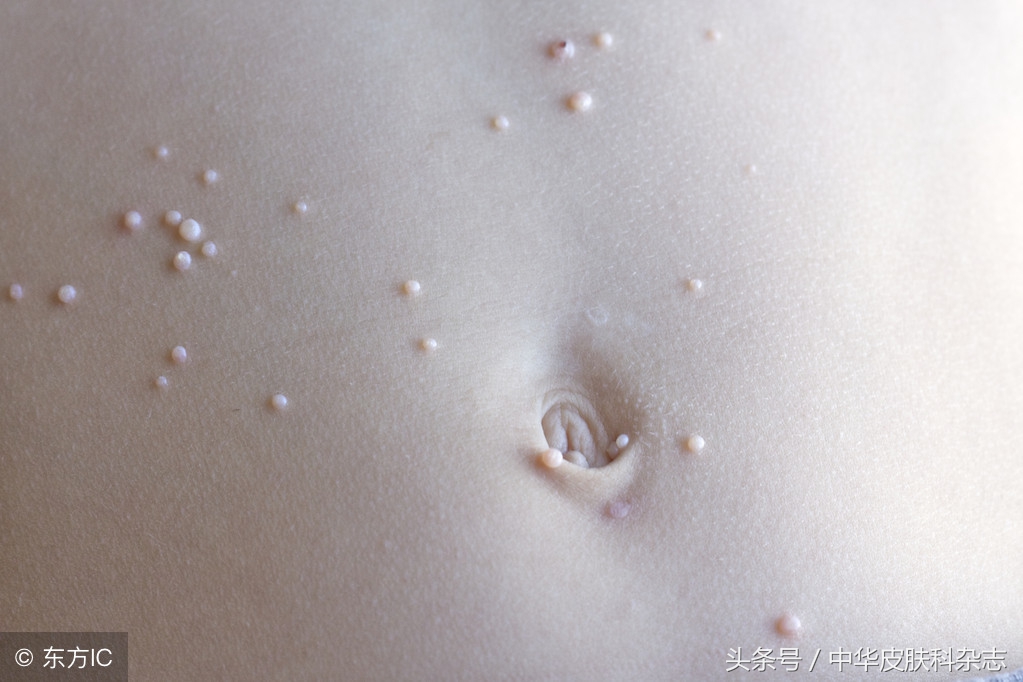 传染性软疣儿童怎么治,传染性软疣刮除有多疼