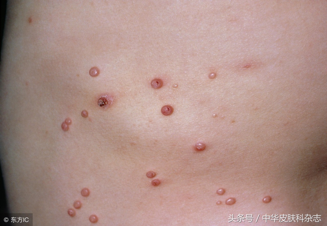 传染性软疣儿童怎么治,传染性软疣刮除有多疼