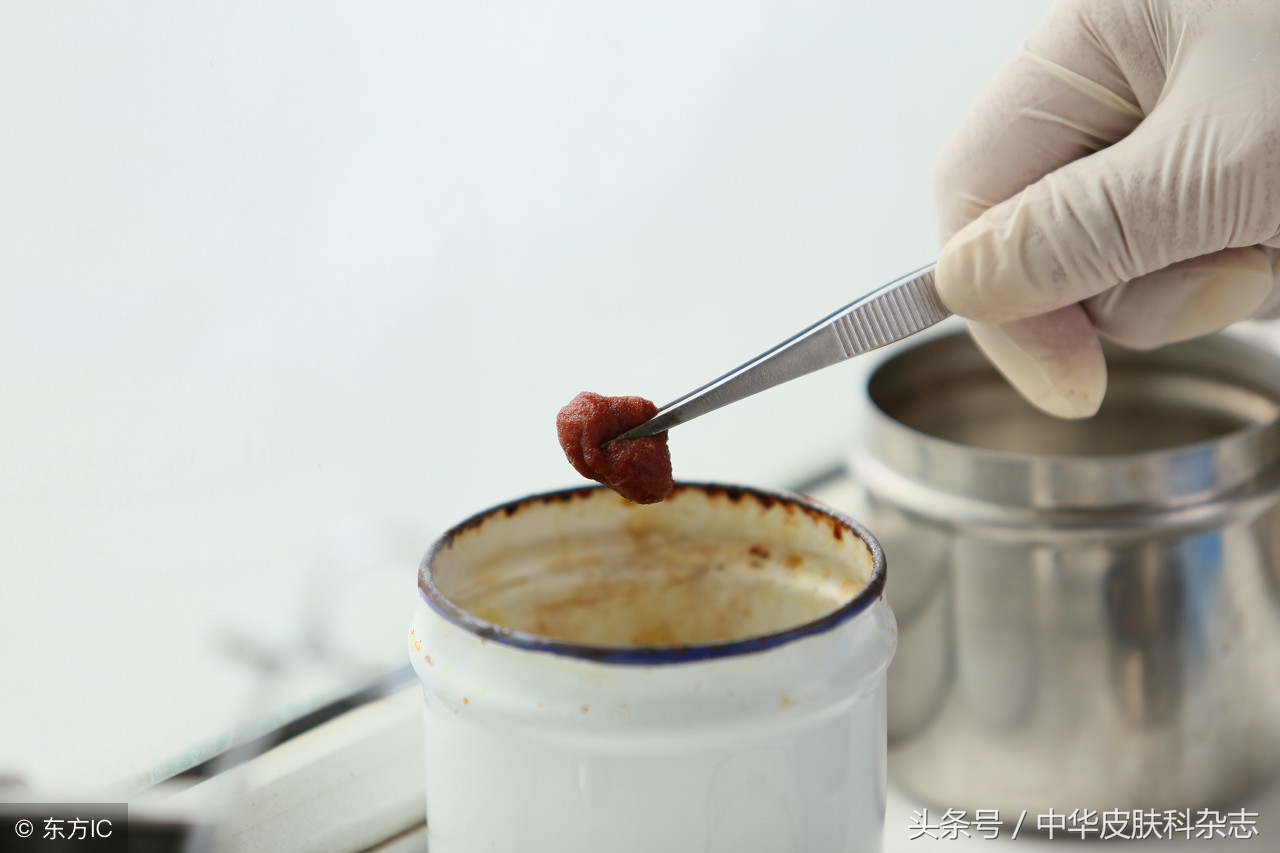 传染性软疣儿童怎么治,传染性软疣刮除有多疼