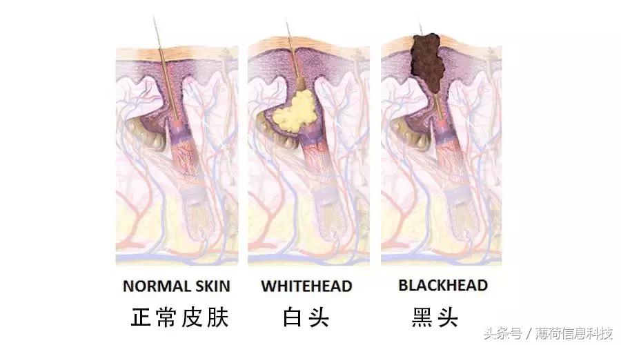 看完这篇,痘痘黑头通通灭掉