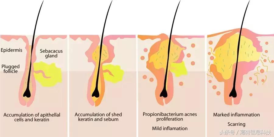 看完这篇,痘痘黑头通通灭掉