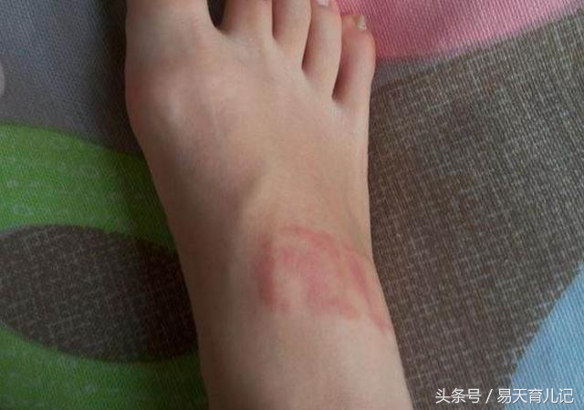 宝宝身上起小红疙瘩，父母注意啦，这可不是蚊子包，别不当回事儿
