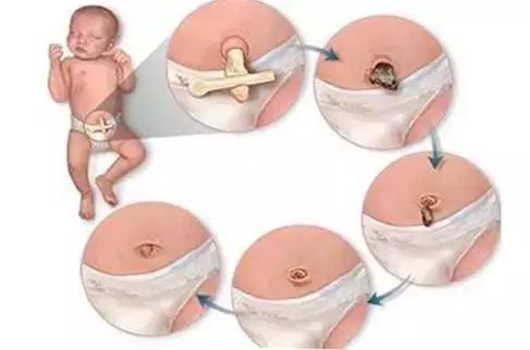 肚脐眼的泥巴掏出来会怎么样,肚脐里面脏东西可以掏出来吗