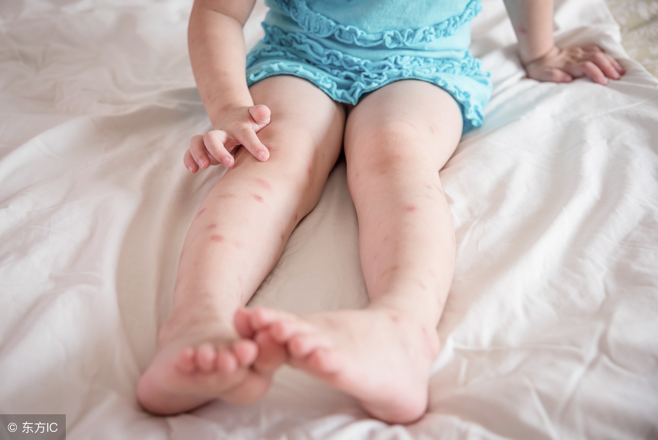 一女子被蚊虫叮咬,女子蚊子叮咬急诊