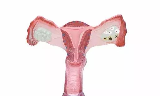 贫穷还是暴富？促排卵取卵，会不会使女性衰老提前？