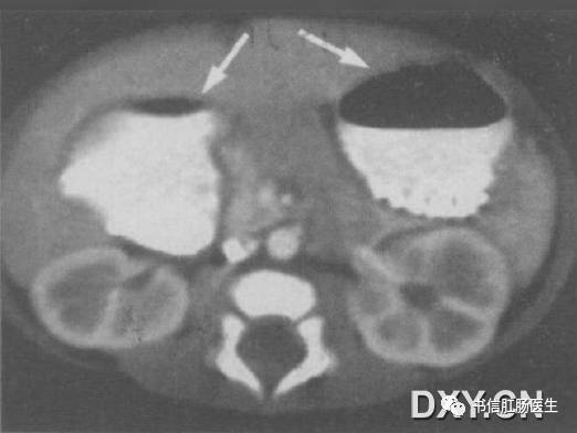 10种经典肠道影像征象:绳征、串珠征、螺纹征……你听过几个?