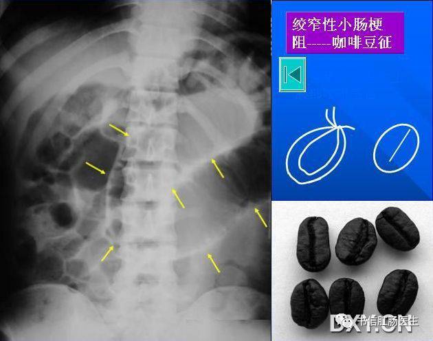 10种经典肠道影像征象:绳征、串珠征、螺纹征……你听过几个?