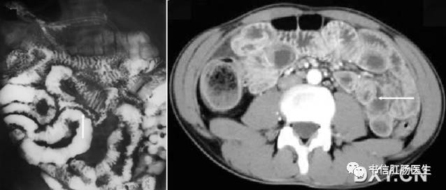 10种经典肠道影像征象:绳征、串珠征、螺纹征……你听过几个?