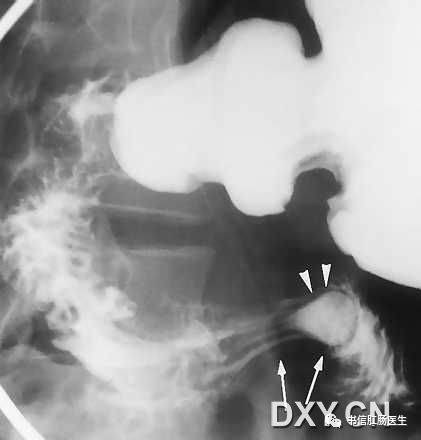 10种经典肠道影像征象:绳征、串珠征、螺纹征……你听过几个?