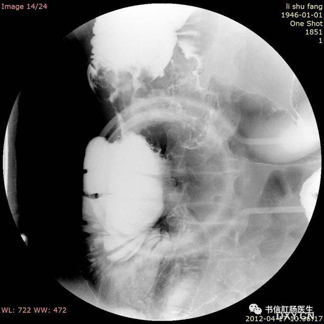 10种经典肠道影像征象:绳征、串珠征、螺纹征……你听过几个?
