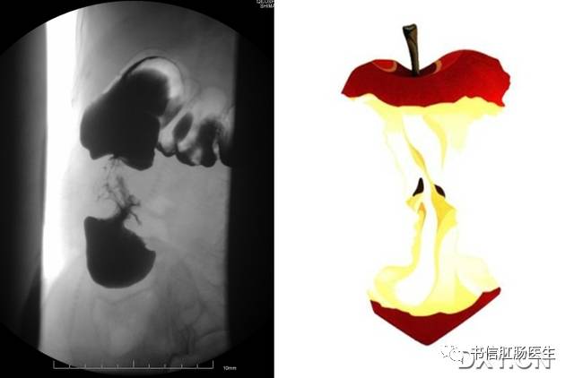 10种经典肠道影像征象:绳征、串珠征、螺纹征……你听过几个?
