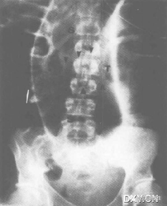 10种经典肠道影像征象:绳征、串珠征、螺纹征……你听过几个?