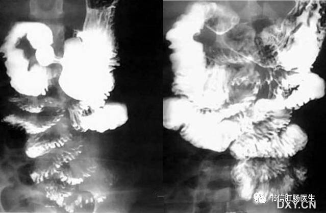 10种经典肠道影像征象:绳征、串珠征、螺纹征……你听过几个?