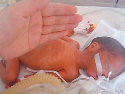 孕32周羊水破了还有点血,孕32周羊水早破保胎4天有淡红色血