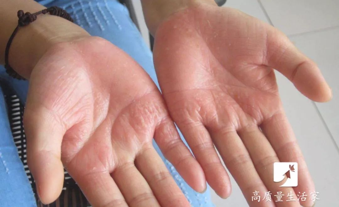 手上长水泡非常痒别抓这样处理,手上起小水泡很痒有什么土方法