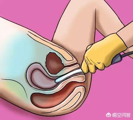 阴道超声报告卵巢多囊性改变,是怎么回事?需要治疗吗?