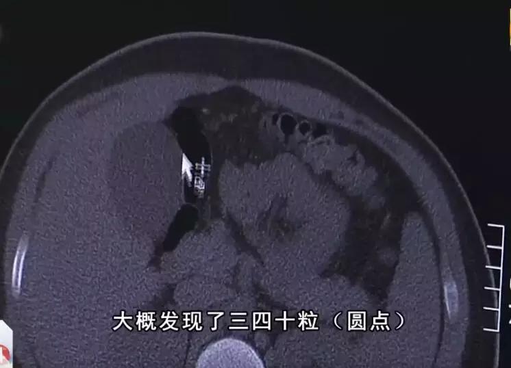 16岁男孩喝珍珠奶茶没抢救过来,男孩喝完珍珠奶茶胃里全是珍珠