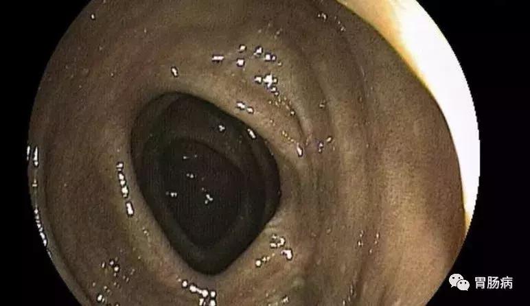 老年人便秘的原因和治疗,老年人便秘的症结在哪里