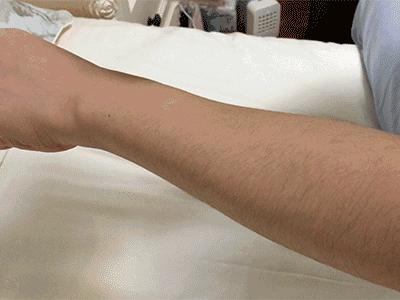 腋下不干净有干皮,腋下不干净会导致狐臭吗