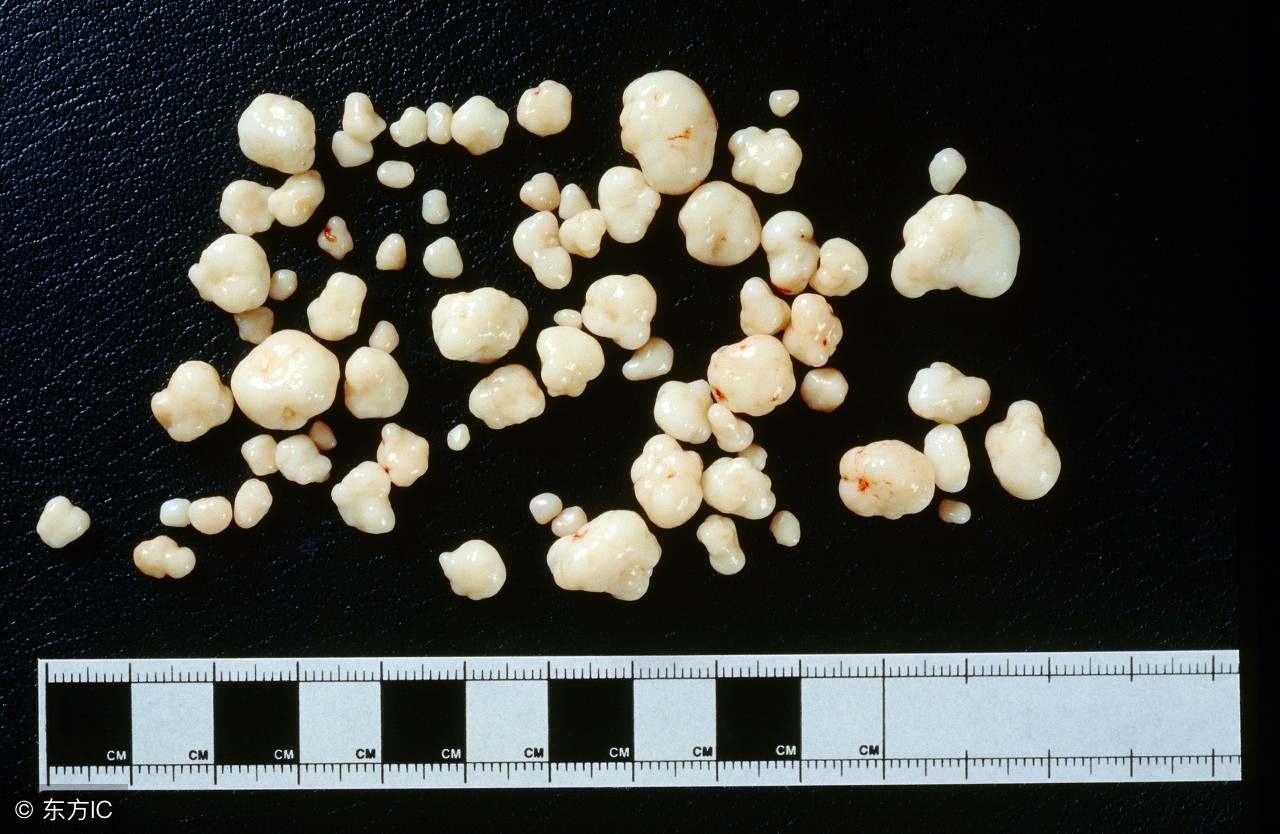 膝盖弯曲时嘎吱响有时好像卡住了,膝盖的骨头一动就咔咔响会瘫痪么