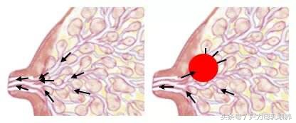 产后束缚有必要吗,产后催乳需要热敷吗