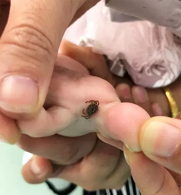 潍坊所有的家长,这种虫子传播新型艾滋病,最喜欢叮咬孩子……