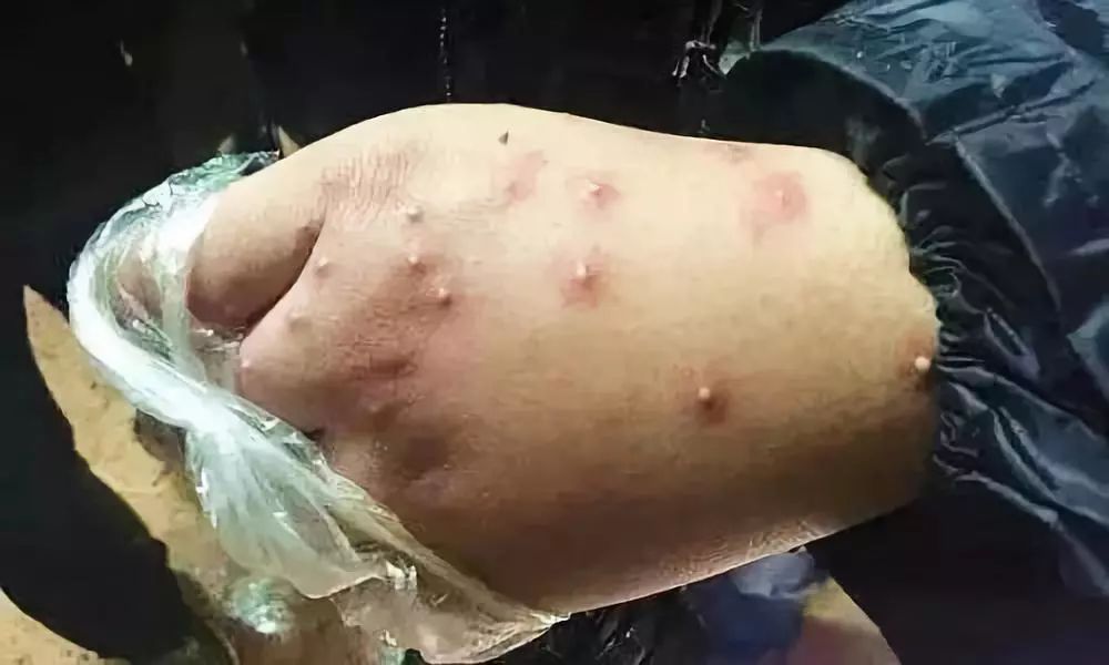 潍坊所有的家长,这种虫子传播新型艾滋病,最喜欢叮咬孩子……