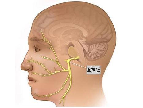 面肌痉挛能自己治愈吗,针灸能不能治愈面肌痉挛