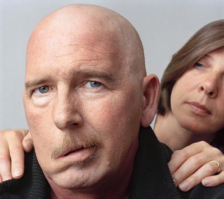 面肌痉挛能自己治愈吗,针灸能不能治愈面肌痉挛