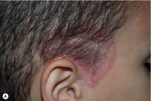 银屑病是什么样的病症,银屑病是免疫系统疾病